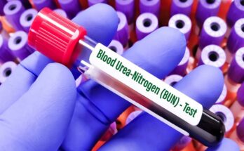 The Blood Urea Nitrogen